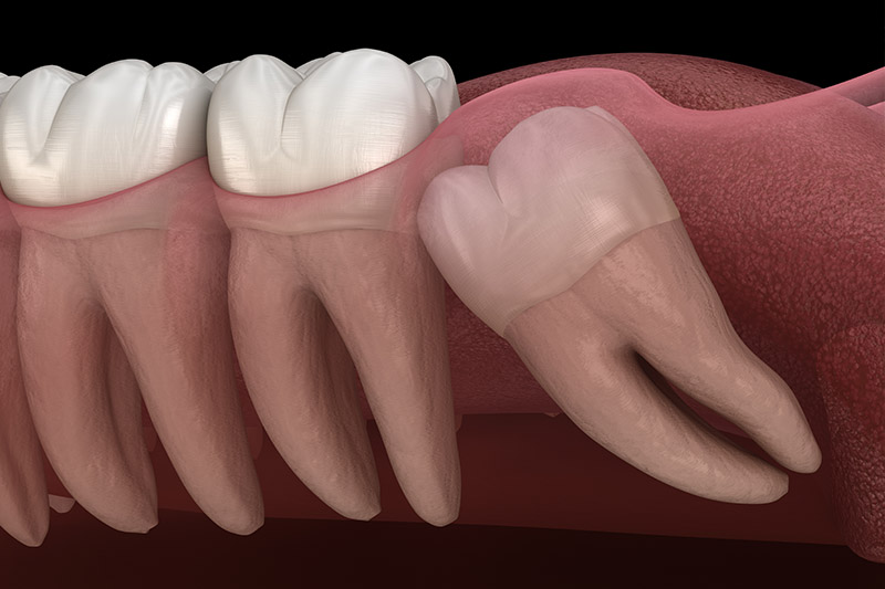 Tooth Extraction in La Grange
